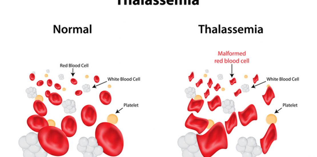 Bệnh Thalassemia: Hiểu biết, phòng tránh và cách điều trị