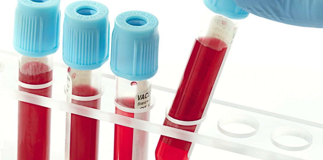 Một xét nghiệm máu phát hiện chín loại ung thư